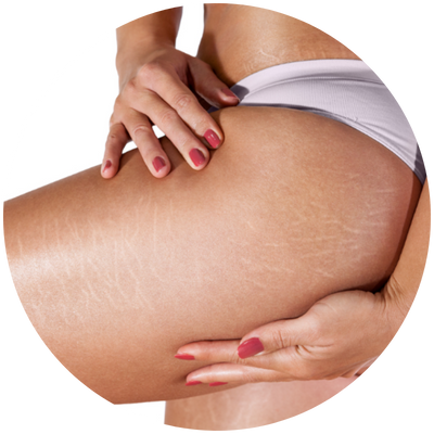 Tratamento de Estrias